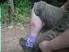 The result of leeches!!!